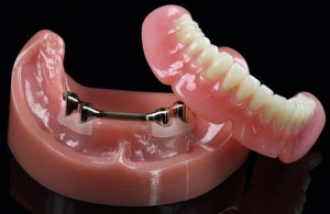 overdenture