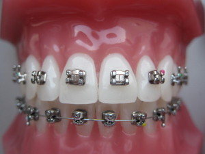 ortodontske-bravice-001