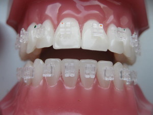 ortodontske-bravice-004