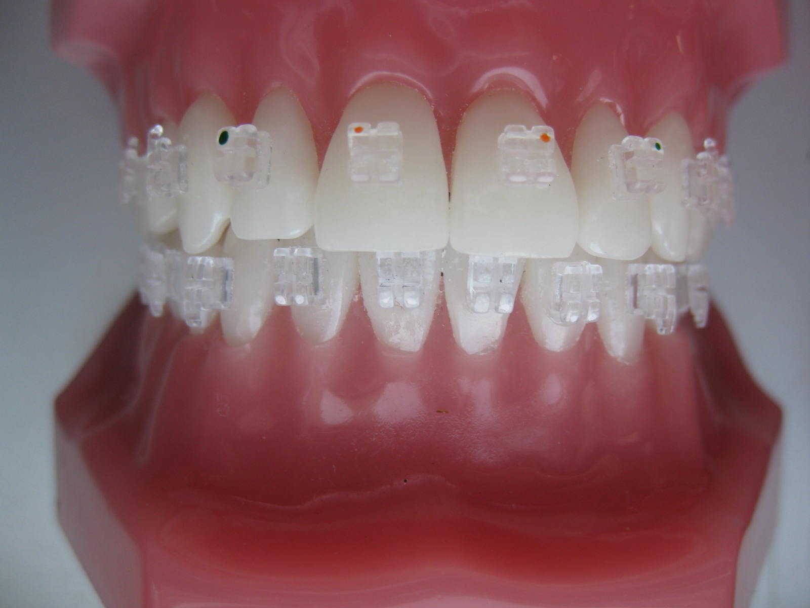 Apparecchi Ortodontici Fissi Turismo Dentale Aponia Dental Apparecchi Ortodontici Fissi Turismo Dentale Aponia Dental