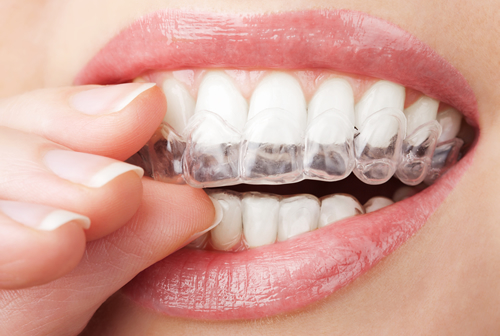 I denti “consumati” – come prevenire questo fenomeno?