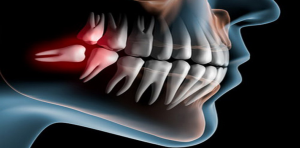 denti-del-giudizio-aponija-blog