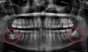 denti-del-giudizio-blog