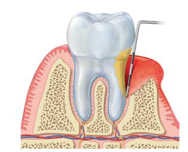 Parodontite – malattia dell’uomo moderno